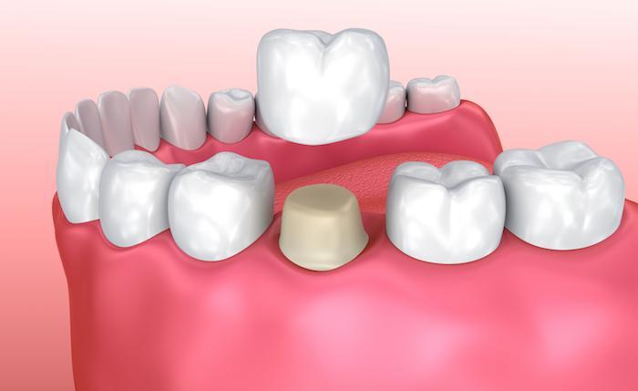 How Dental Crowns Support Teeth After Root Canal Treatments