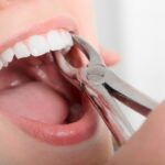 How To Choose Between Simple and Surgical Tooth Extractions