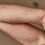 The Most Common Drug Allergies and How They’re Treated