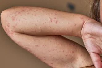 The Most Common Drug Allergies and How They’re Treated