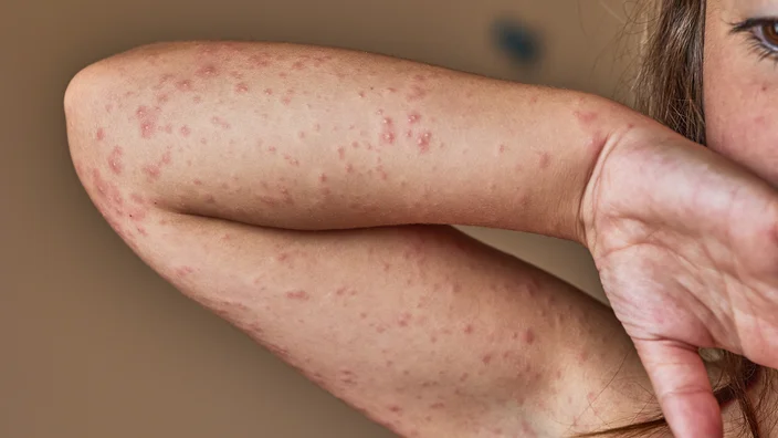 The Most Common Drug Allergies and How They’re Treated