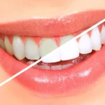 The Truth About Teeth Whitening: What Works and What Doesn’t
