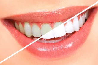 The Truth About Teeth Whitening: What Works and What Doesn’t