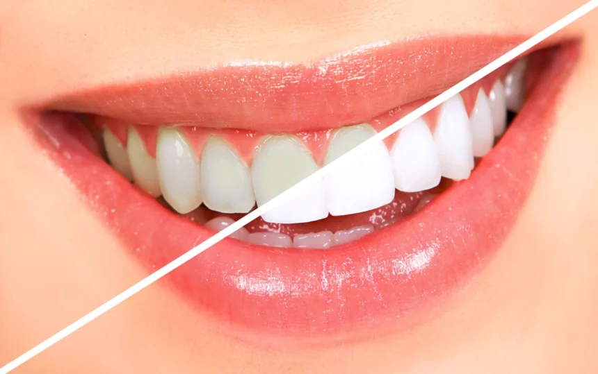 The Truth About Teeth Whitening: What Works and What Doesn’t