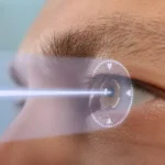 Contoura LASIK