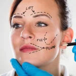 Face Lift Surgery