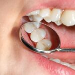 Fillings for Your Teeth