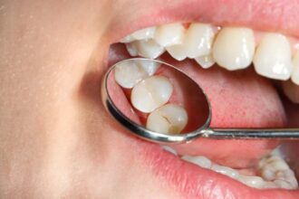 Fillings for Your Teeth