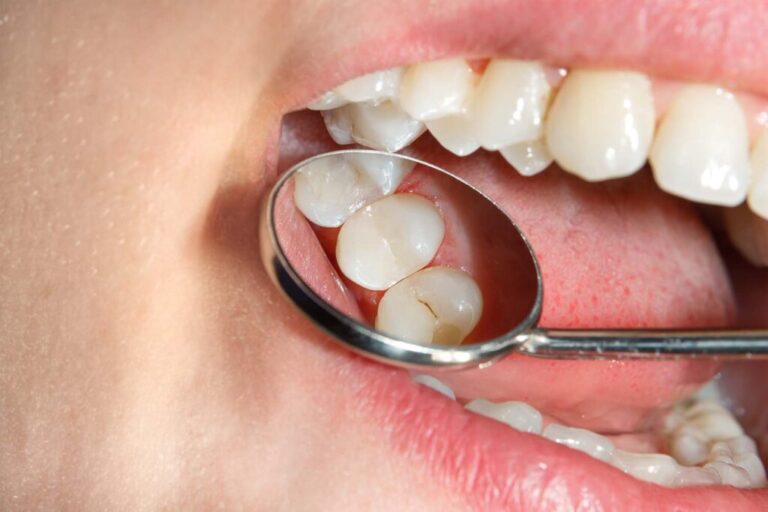 Fillings for Your Teeth