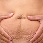 Tummy Tuck