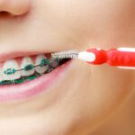 Care for Your Braces