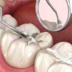 Dental Sealants in Protecting Teeth