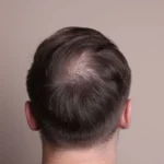 Hair Loss in Your 30s