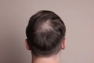 Hair Loss in Your 30s