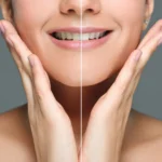 Professional Teeth Whitening