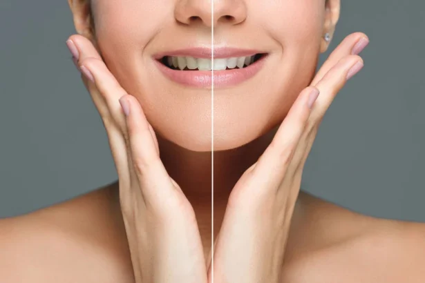 Professional Teeth Whitening