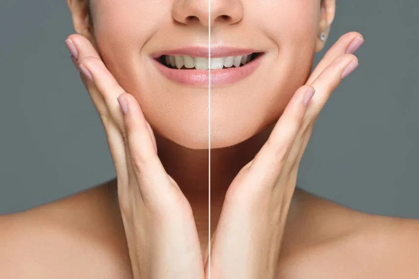 Professional Teeth Whitening
