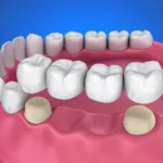 Right Bridge for Your Dental Needs