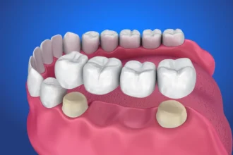 Right Bridge for Your Dental Needs