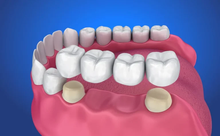 Right Bridge for Your Dental Needs