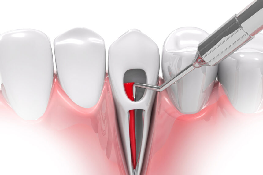 Root Canal