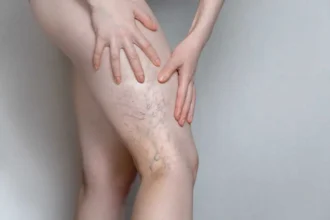 Varicose Veins