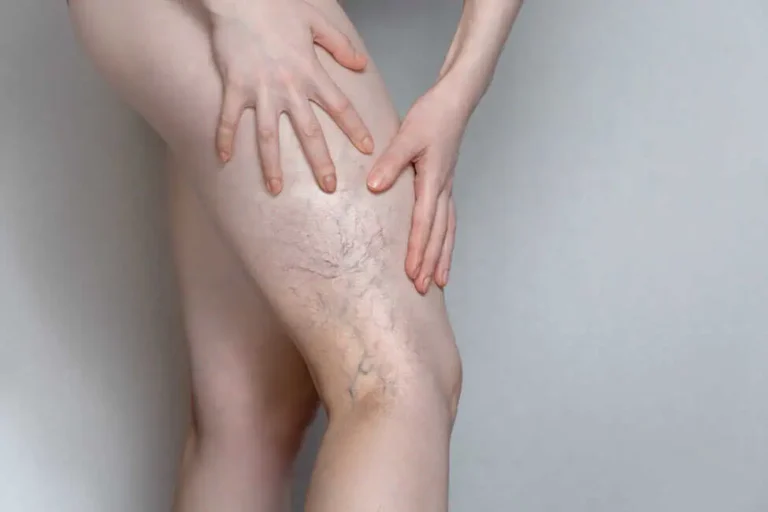 Varicose Veins