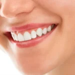 Teeth Whitening