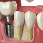 Dental Implant Procedure