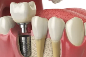 Dental Implant Procedure