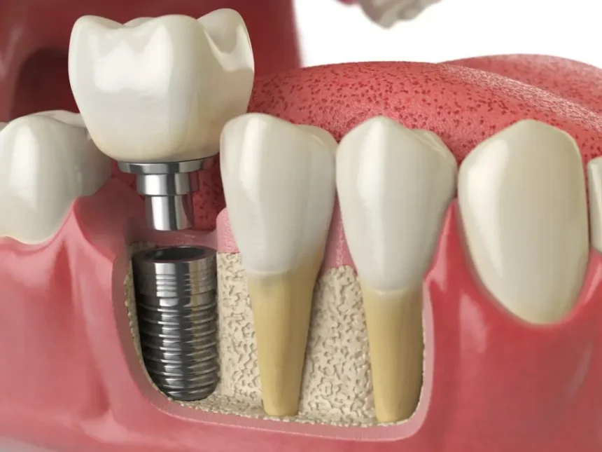 Dental Implant Procedure