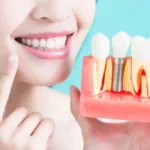 Dental Implants for a Confident Smile