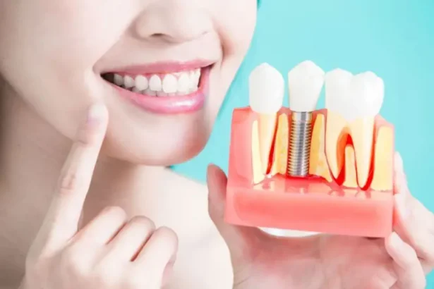 Dental Implants for a Confident Smile