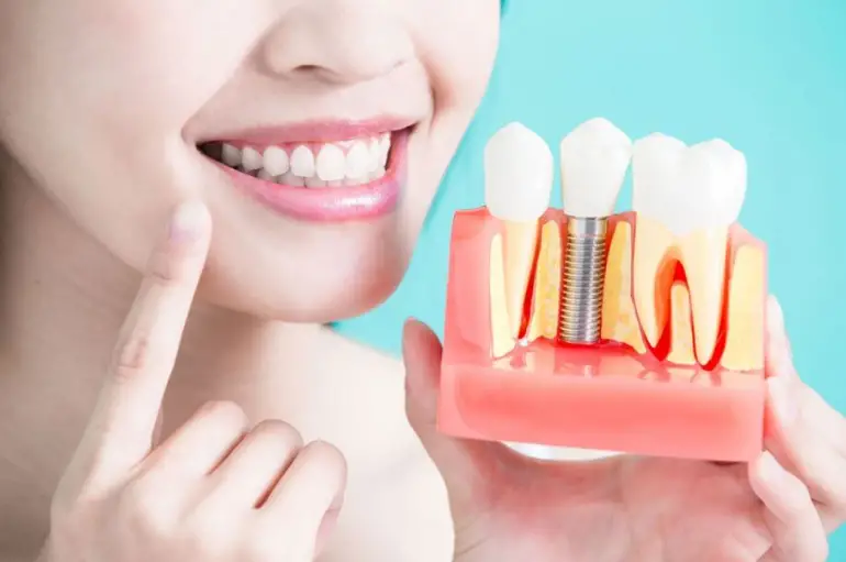 Dental Implants for a Confident Smile