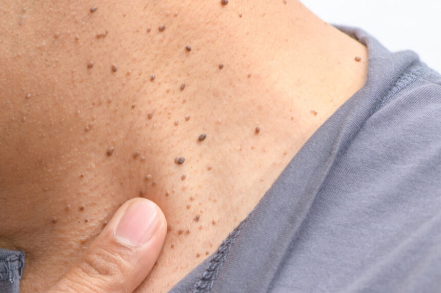 Seborrheic Keratosis