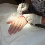 Skin Cancer Surgery