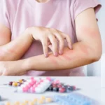 Symptoms of Drug Allergies