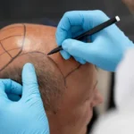Techniques of Hair Transplantation