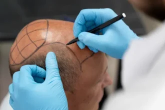 Techniques of Hair Transplantation