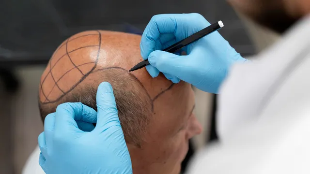 Techniques of Hair Transplantation