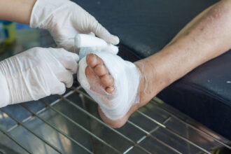 Amputation in Diabetic Patients