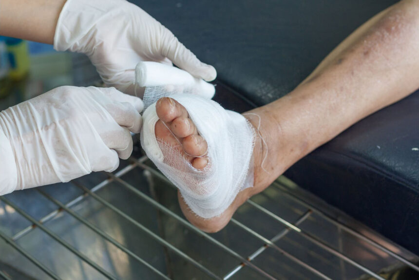 Amputation in Diabetic Patients