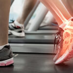Ankle Replacement