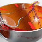 Different Types of Glaucoma