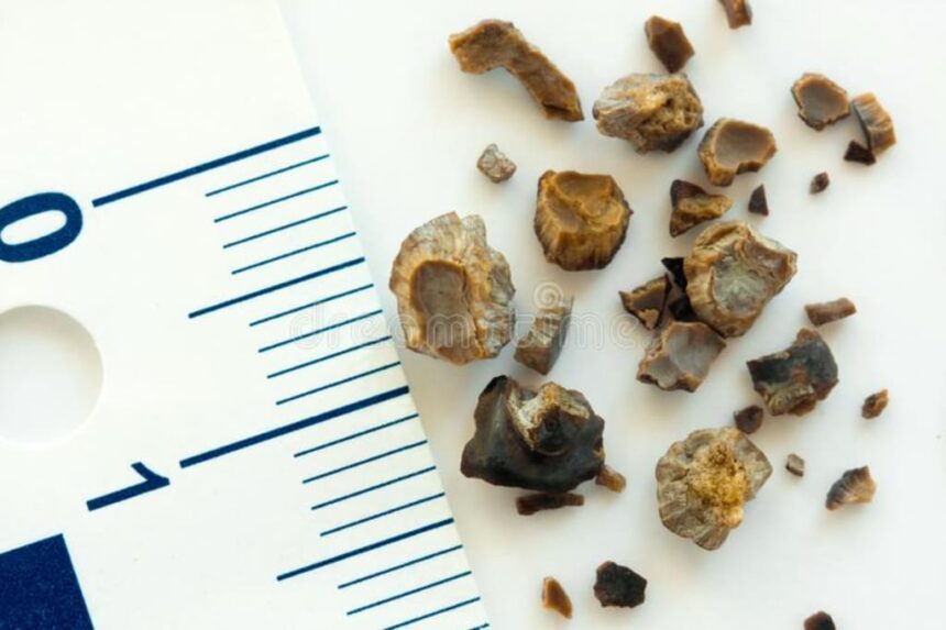 Different Types of Kidney Stones