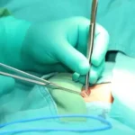 Hernia Repair Surgeon