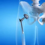 Hip Replacement Surgery