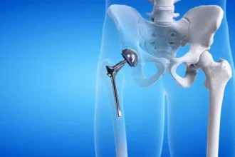 Hip Replacement Surgery