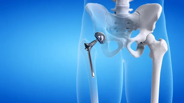 Hip Replacement Surgery