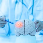 Impact of Stroke on Cognitive Function